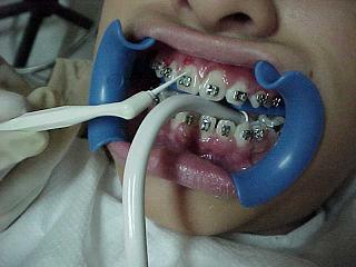 Más de 64.000 niños granadinos de entre 6 y 12 años recibirán asistencia dental gratuita. No hay límite de edad para cualquier discapacitado