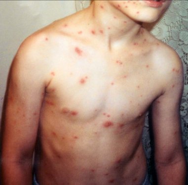 Los casos de varicela aumentan en España y hay orden de no comercializar la vacuna ¿Por qué?